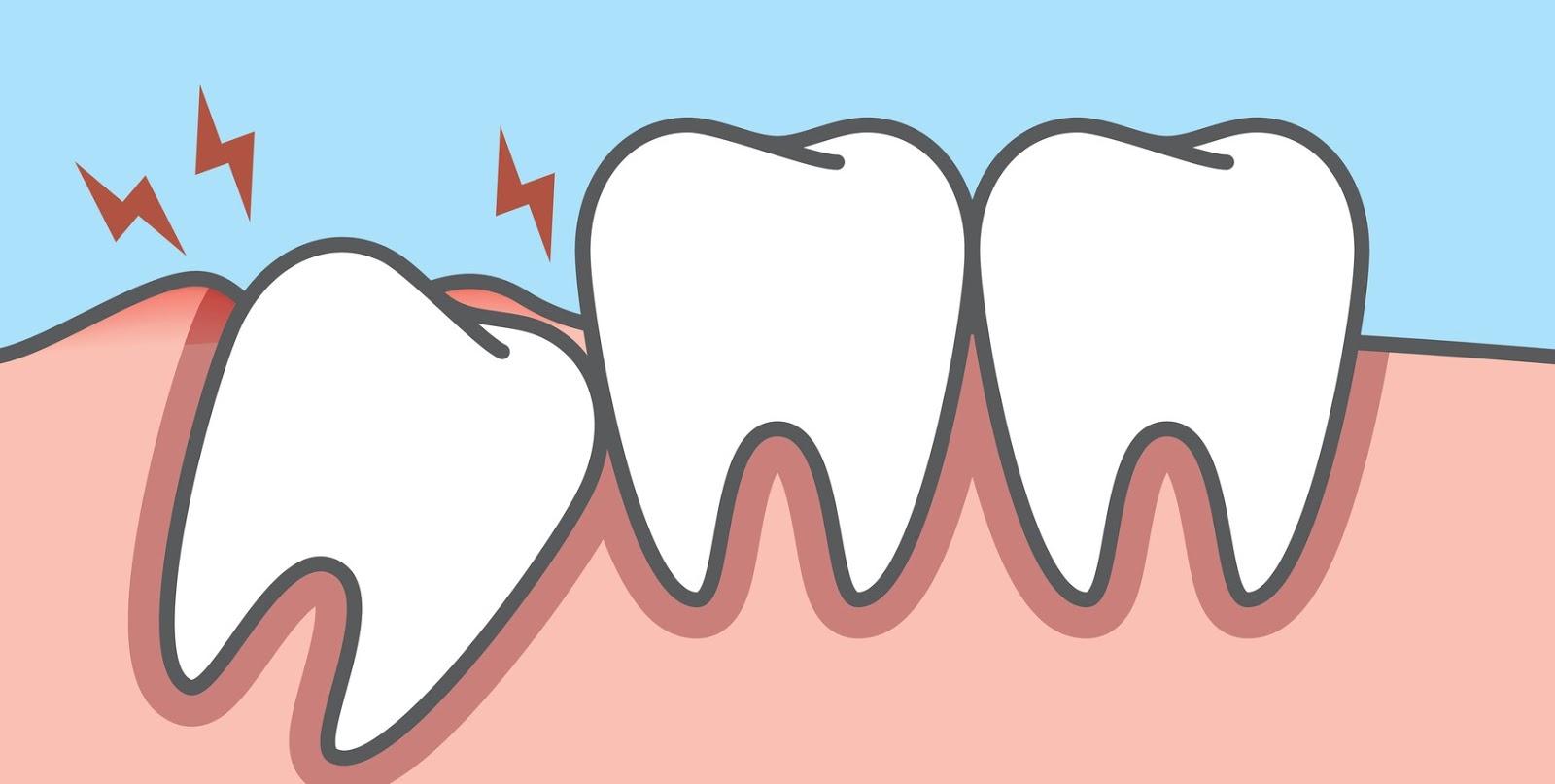 Perché si perdono i denti?